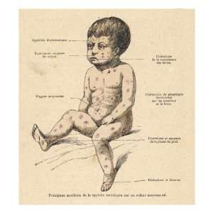  Diagram of a New Born Baby with Inherited Syphilis 