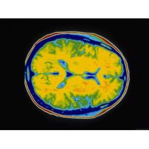 Normal MRI Head Transverse Magnetic Resonance Image Collections 