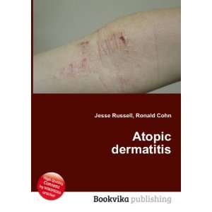  Atopic dermatitis Ronald Cohn Jesse Russell Books